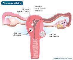 Faux, l’abstinence ne provoque pas le fibrome chez les femmes